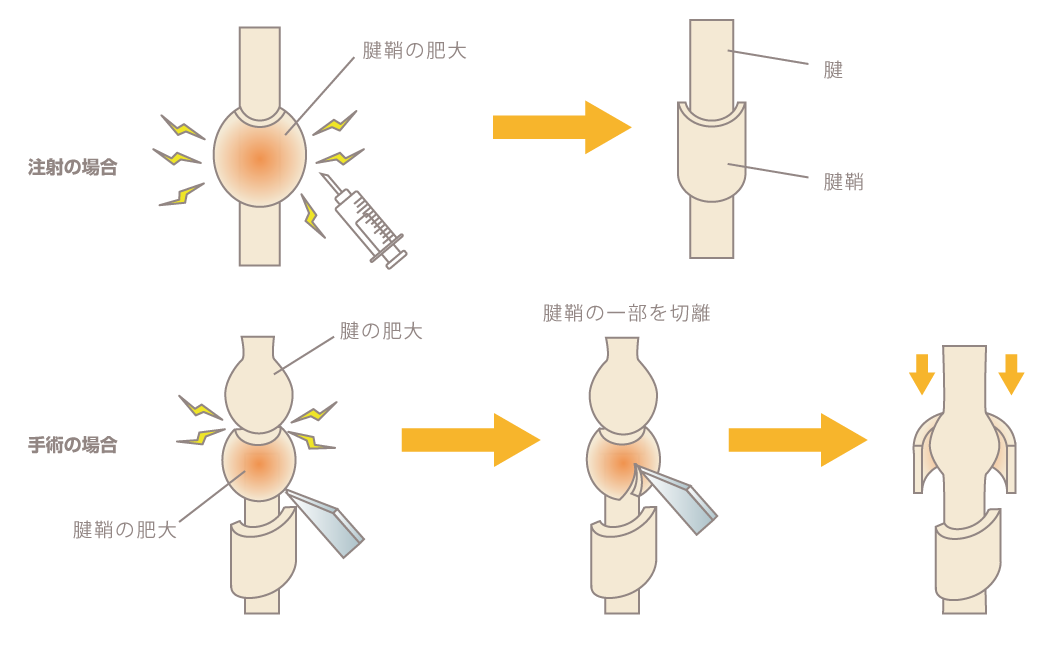 ばね指(腱鞘炎)の治療方法