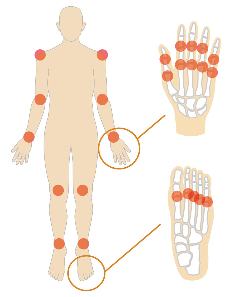 関節リウマチの症状があらわれる主な関節