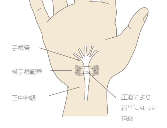 手根管症候群の状態