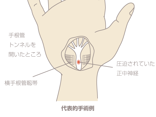 手根管症候群の手術