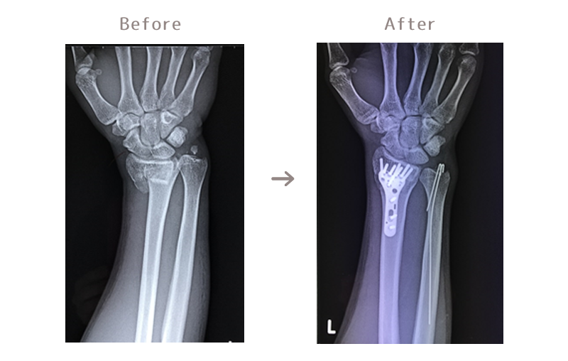 橈骨遠位端骨折骨レントゲン骨の状態